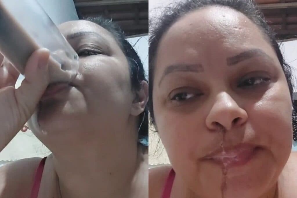Mulher tem “céu da boca” perfurado ao realizar procedimento odontológico no interior do RN