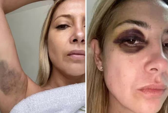 Acusado de agressão, Alberto Fernández diz que olho roxo em ex-primeira-dama foi causado por ‘tratamento contra rugas'