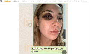 Ex-primeira-dama da Argentina mostra hematomas no olho e no braço após agressões de Alberto Fernández, diz site