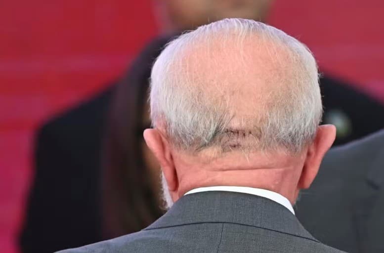 Lula é liberado por médicos para viajar após novos exames apontarem melhora em quadro