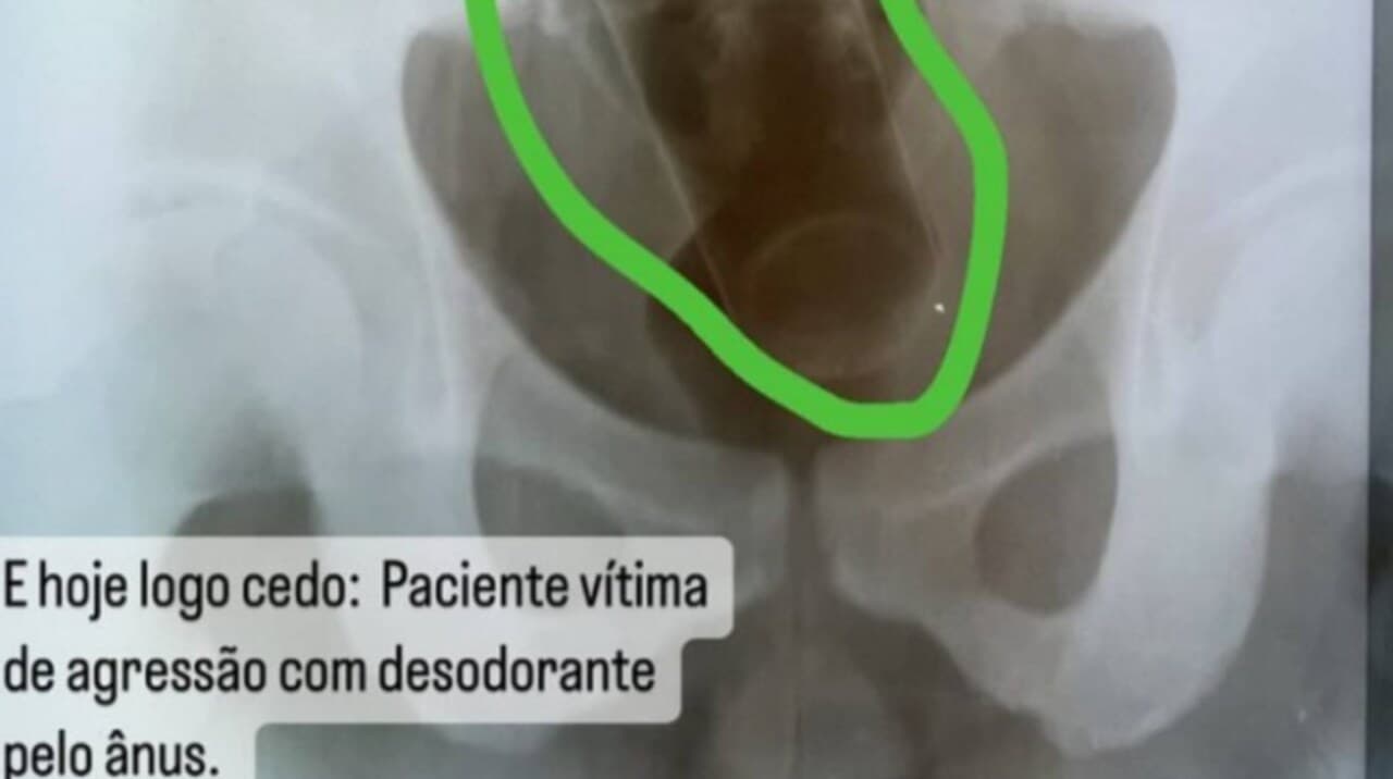 Médico é demitido por vazar raio-x de paciente com desodorante no ânus