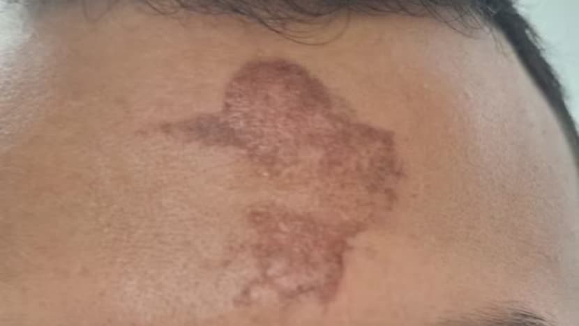 Fiéis relatam queimaduras na testa após receber sinal da cruz com cinzas em missa no RN