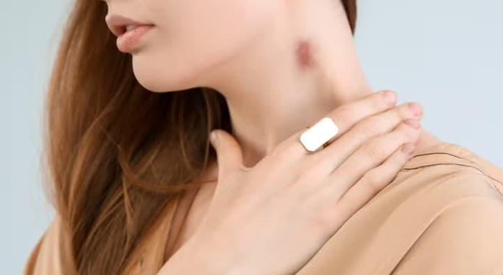 Chupão no pescoço leva mulher a ter AVC; médicos alertam para riscos da prática
