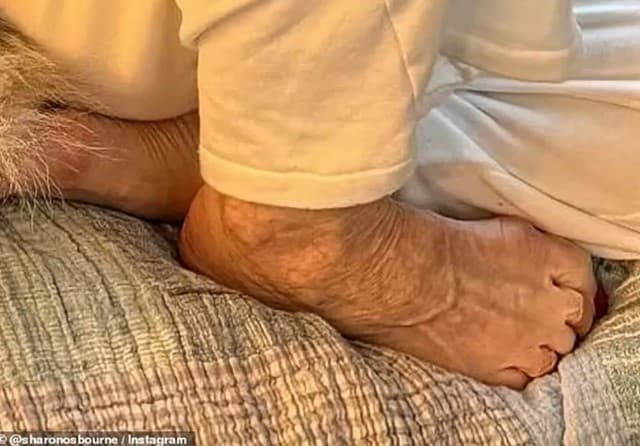 ‘Pé de Ozempic' vira pesadelo estético para quem busca o corpo perfeito