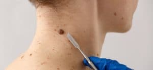 Cientistas do RN criam moléculas que podem frear o melanoma, câncer de pele mais letal do Brasil