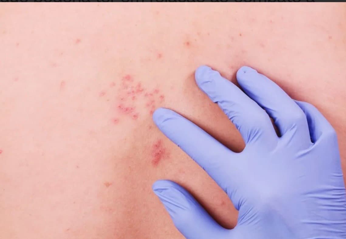 Ministério da Saúde decide não incorporar vacina do herpes zóster ao SUS