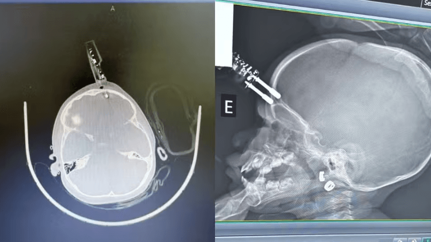 Menina de 1 ano que teve um carregador de celular cravado na testa ao cair da cama recebe alta médica após cirurgia