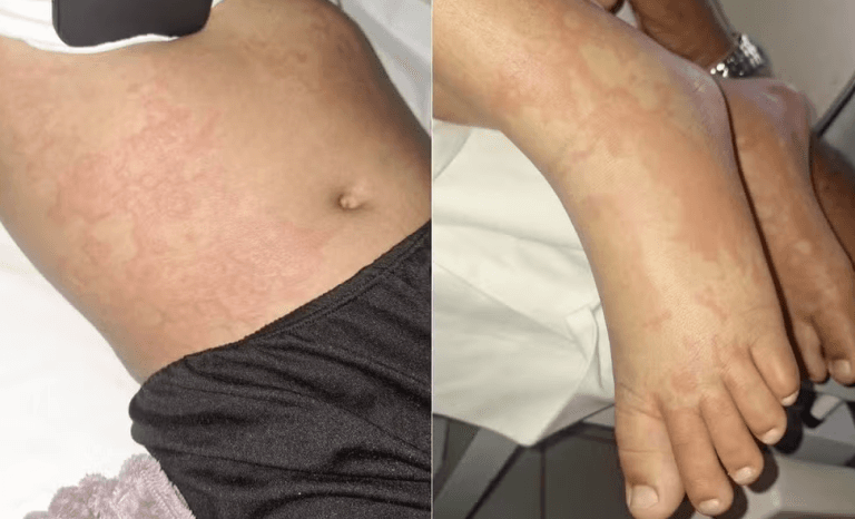 Criança é internada em Natal com infecção bacteriana e família associa caso a detergente