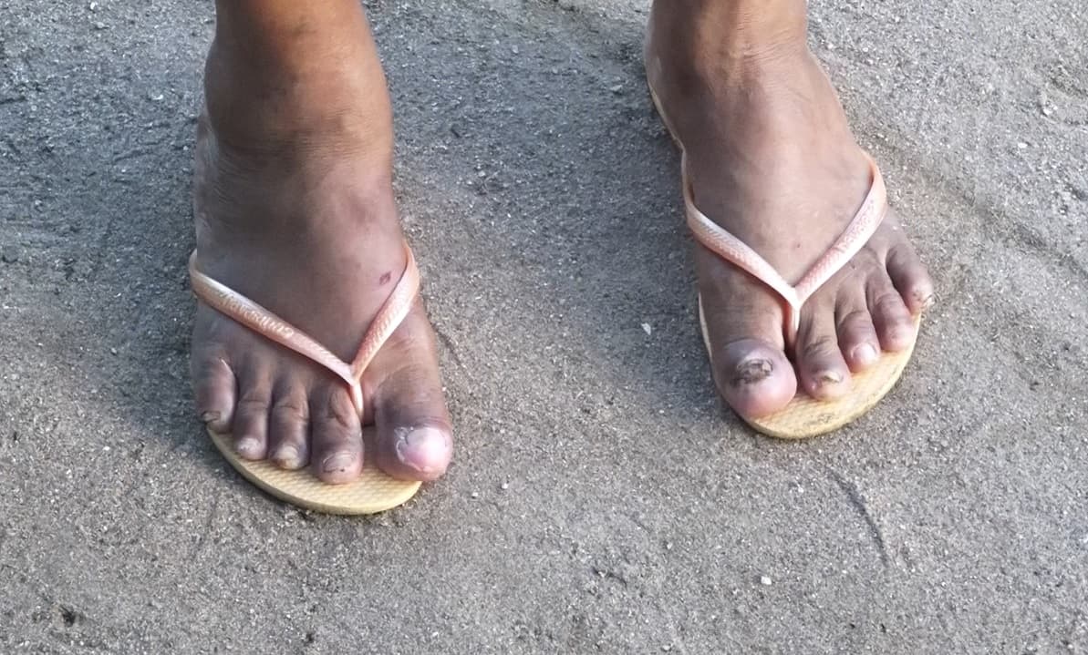 O surto de bicho-de-pé que preocupa moradores de comunidade na zona Norte de Natal